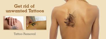laser tattoo removal cosmetic surgery