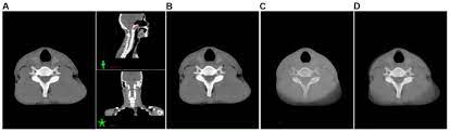 guided nasopharyngeal carcinoma