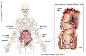 bowel obstruction or intestinal