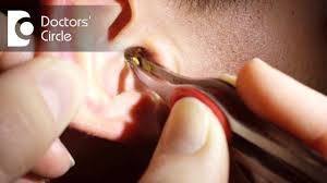 Learn how you can properly clean your ears and remove earwax buildup. Best Way To Clean Wax From Your Ears Dr Satish Babu K Youtube