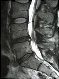 The Office  DNA Live Case Study   Chronic Spinal Lower Back Pain   Full  Length SlideShare