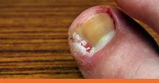 urgent care for toenail injuries