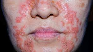 what is nummular eczema symptoms