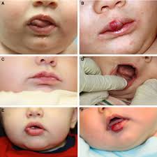 infantile hemangiomas of the lip