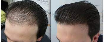 low cost hair transplant solution at