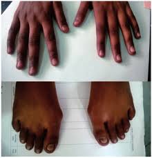 knuckle hyperpigmentation and nail