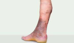 ankle discoloration causes and