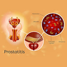 prostais prostate infection