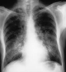 Mujer de 80 años con importante fibrosis pulmonar en rx de tórax el electrocardiograma con importante crecimiento y sibrecarga del ventrículo derecho por. Hemorragia Alveolar Difusa Trastornos Pulmonares Manual Msd Version Para Profesionales