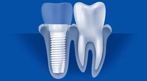 ceramic implants dentist in santa
