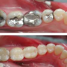Image result for tooth colored fillings