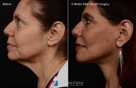 lower facelift surgery new jersey
