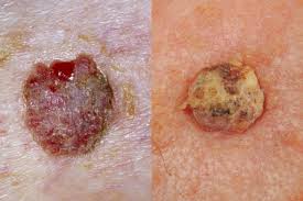 skin cancer pictures 5 diffe