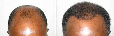 Hair transplant before and afters view the world's largest photo gallery of patient results. African American Hair Transplants Limmer Htc San Antonio Tx