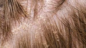 scalp eczema definition treatment