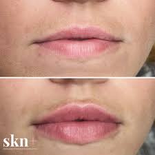 lip fillers in stone by stafford