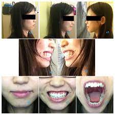profile by having orthodontic treatment