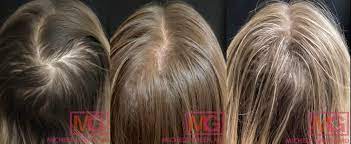 hair loss caused by stress losing hair