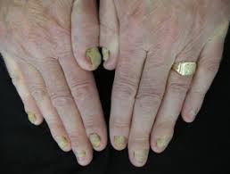 We did not find results for: Nail Terminology Dermnet Nz