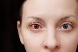 what causes pink eye and how do you