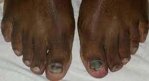 black toenails infection or