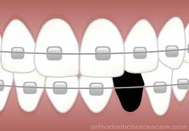Learn how your dental team can push your teeth if your teeth move after braces, don't despair. Can Braces Really Close Missing Tooth Gap Orthodontic Braces Care