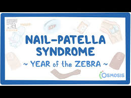 nail patella syndrome year of the