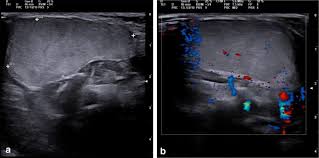 imaging of head and neck lipoblastoma