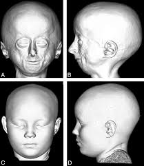 Resultado de imagen de progeria de hutchinson-gilford