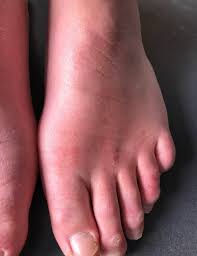 The hand and foot rash caused by this condition sometimes causes blistering to occur, and may be painful, but not itchy. Is My Skin Rash A Covid 19 Symptom