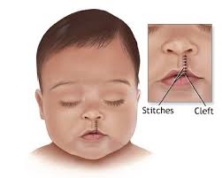 cleft lip surgery cost in india