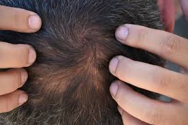 Treatments to promote hair regrowth work in some cases, but often the hair regrows of its own accord. Telogen Effluvium Symptoms Treatment And Recovery