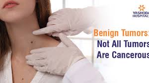 understanding benign tumours not all