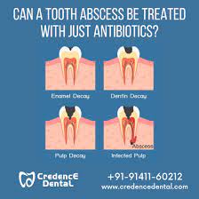 can a tooth abscess be treated with