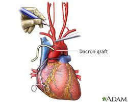 Dacron Graft Placement Mclaren Health Information Health