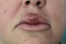 granulomatous cheilitis a report of 6