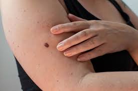 a mole and skin cancer