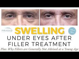 eyes with cosmetic fillers