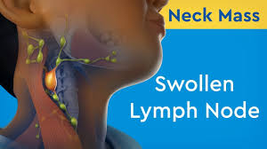 neck m swollen lymph node you