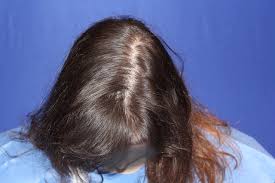hair loss in women trichostem hair