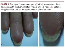 pterygium inversum unguis report of an