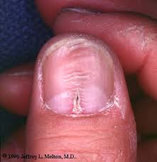 an nail dystrophy