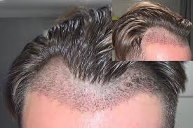 1700 graft frontal zone fut. What You Need To Know About Shedding After A Hair Transplant
