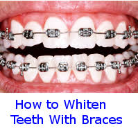 How do you brush your teeth with baking soda? How To Whiten Teeth With Braces On 2 Of The Best Solutions