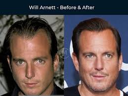 59 celebrity hair transplants before