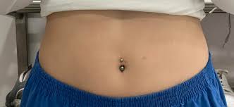 belly piercing 4 benefits and treatment