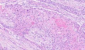 pulmonary squamous cell carcinoma and