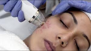 Best Acne Scar Treatment & Scar Removal in Mumbai