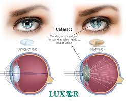 cataract causes symptoms treatment