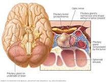 Image result for icd 10 code for high prolactin